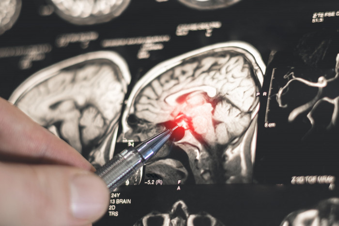 اكتشاف روسي جديد يفتح الطريق لتطوير أدوية لعلاج باركنسون اكتشاف روسي جديد يفتح الطريق لتطوير أدوية لعلاج باركنسون