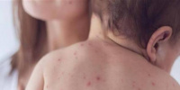 بنجلادش تواجه أسوأ موجة انتشار للحصبة بسبب تراجع التطعيم